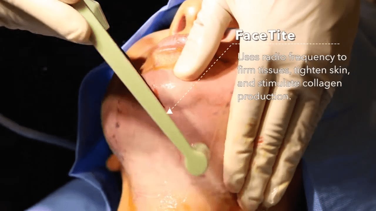 Person undergoing FaceTite procedure