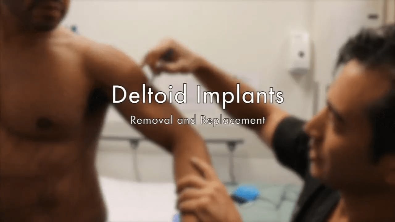 Deltoid implants
