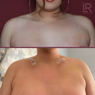 Clavicle Shortening Before & After Gallery - Patient 409468 - Image 1