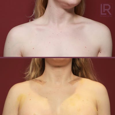 Clavicle Shortening Before & After Gallery - Patient 337081 - Image 1