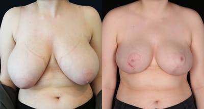 Breast Reduction Before & After Gallery - Patient 417093 - Image 1