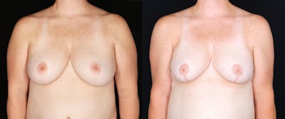 Breast Reduction Before & After Gallery - Patient 307350 - Image 1