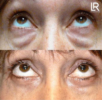 Eyelid Lift Before & After Gallery - Patient 309393 - Image 1