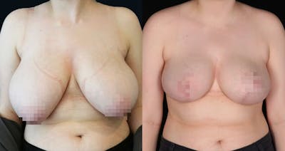 Breast Lift Before & After Gallery - Patient 411396 - Image 1