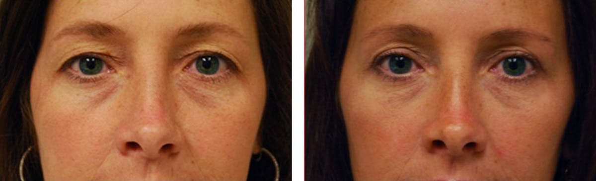 Eyelid Surgery Before & After Gallery - Patient 176795162 - Image 1