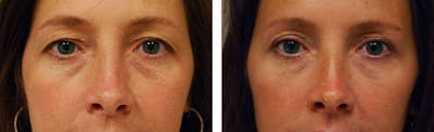 Eyelid Surgery Before & After Gallery - Patient 176795162 - Image 1