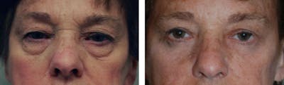 Eyelid Surgery Before & After Gallery - Patient 176795164 - Image 1