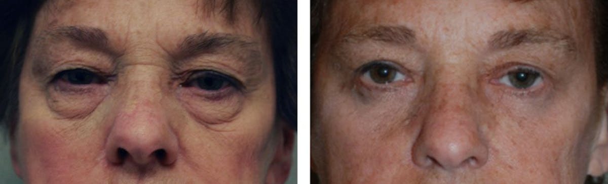 Eyelid Surgery Before & After Gallery - Patient 176795164 - Image 1
