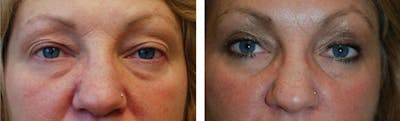 Eyelid Surgery Before & After Gallery - Patient 176795166 - Image 1