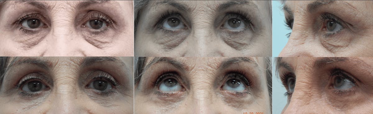 Eyelid Surgery Before & After Gallery - Patient 176795172 - Image 1