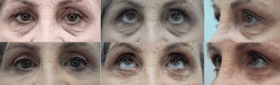 Eyelid Surgery Before & After Gallery - Patient 176795172 - Image 1