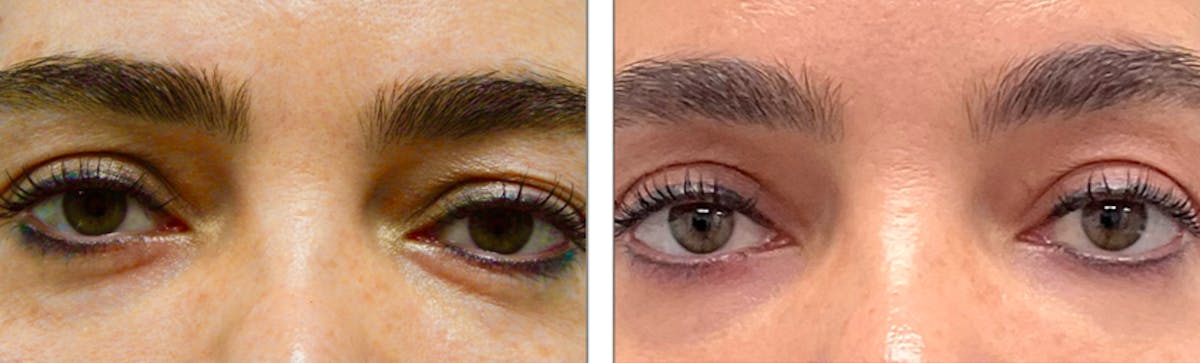 Eyelid Surgery Before & After Gallery - Patient 176795178 - Image 1