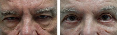 Eyelid Surgery Before & After Gallery - Patient 176795192 - Image 1