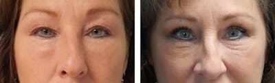 Eyelid Surgery Before & After Gallery - Patient 176795195 - Image 1