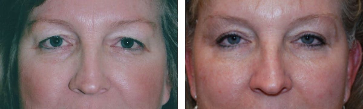 Eyelid Surgery Before & After Gallery - Patient 176795200 - Image 1