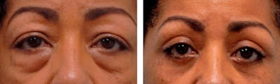 Eyelid Surgery Before & After Gallery - Patient 176795202 - Image 1