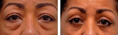 Eyelid Surgery Before & After Gallery - Patient 176795202 - Image 1