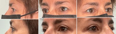 Eyelid Surgery Before & After Gallery - Patient 176795205 - Image 1