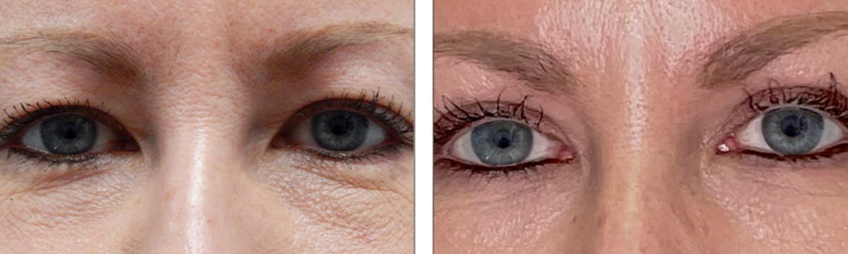 Eyelid Surgery Before & After Gallery - Patient 176795209 - Image 1