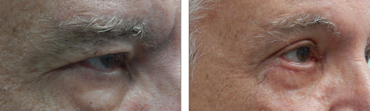 Eyelid Surgery Before & After Gallery - Patient 176795212 - Image 1