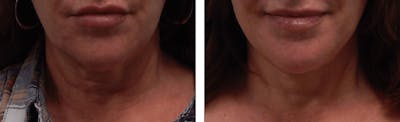 Modified Facelift Before & After Gallery - Patient 176795152 - Image 1