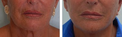 Modified Facelift Before & After Gallery - Patient 176795154 - Image 1