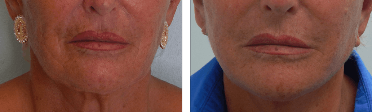 Modified Facelift Before & After Gallery - Patient 176795154 - Image 1