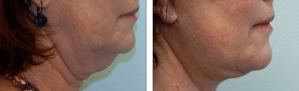Modified Facelift Before & After Gallery - Patient 176795161 - Image 2