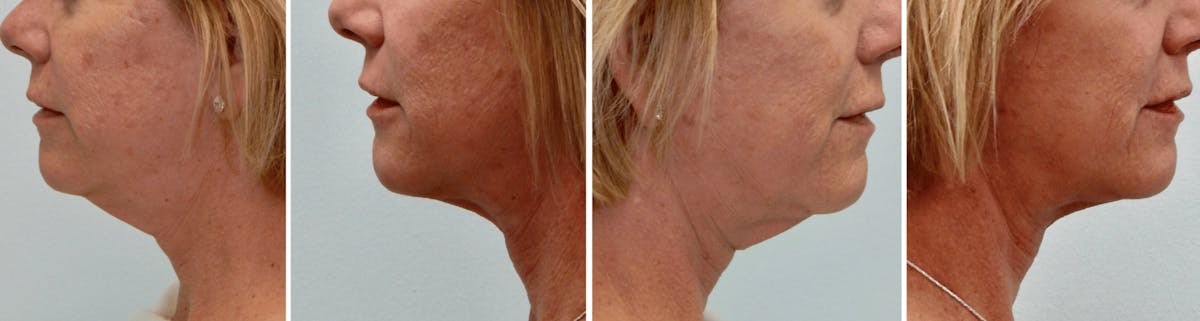 Modified Facelift Before & After Gallery - Patient 176795163 - Image 1