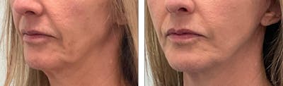 Modified Facelift Before & After Gallery - Patient 176795165 - Image 1