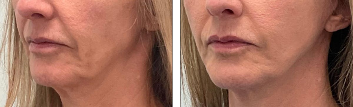 Modified Facelift Before & After Gallery - Patient 176795165 - Image 1