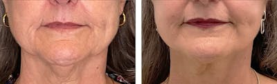 Modified Facelift Before & After Gallery - Patient 176795177 - Image 1