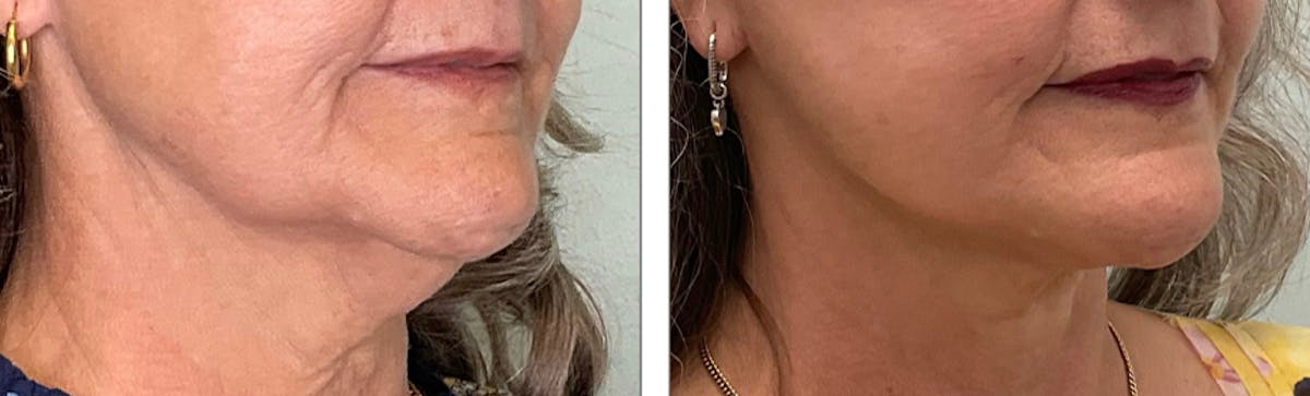 Modified Facelift Before & After Gallery - Patient 176795177 - Image 2
