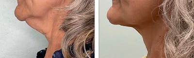 Modified Facelift Before & After Gallery - Patient 176795182 - Image 1