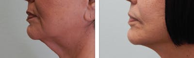 Modified Facelift Before & After Gallery - Patient 176795193 - Image 1
