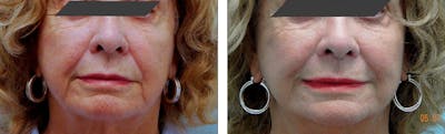 Modified Facelift Before & After Gallery - Patient 176795197 - Image 1