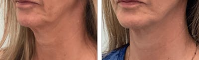 Modified Facelift Before & After Gallery - Patient 176795203 - Image 1