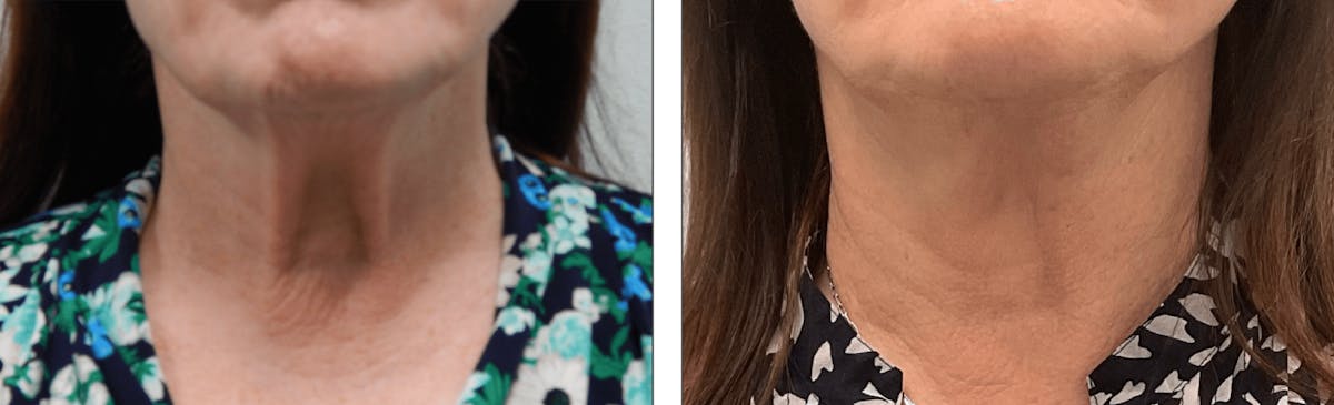 Modified Facelift Before & After Gallery - Patient 176795211 - Image 1