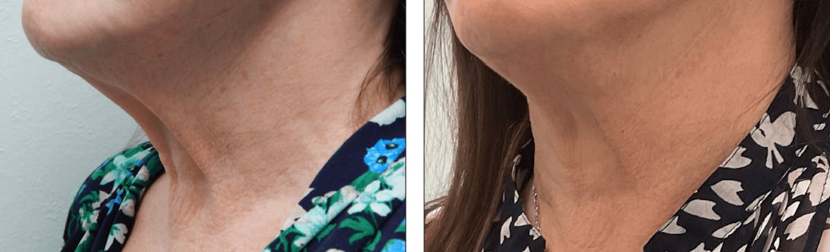 Modified Facelift Before & After Gallery - Patient 176795211 - Image 2