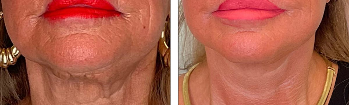 Modified Facelift Before & After Gallery - Patient 176795220 - Image 1
