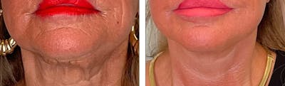 Modified Facelift Before & After Gallery - Patient 176795220 - Image 1