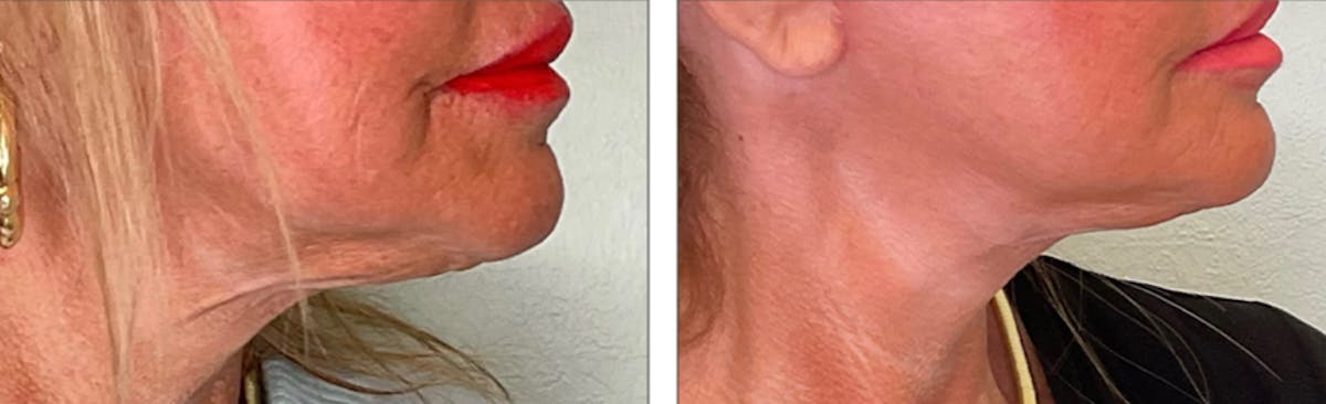 Modified Facelift Before & After Gallery - Patient 176795220 - Image 2