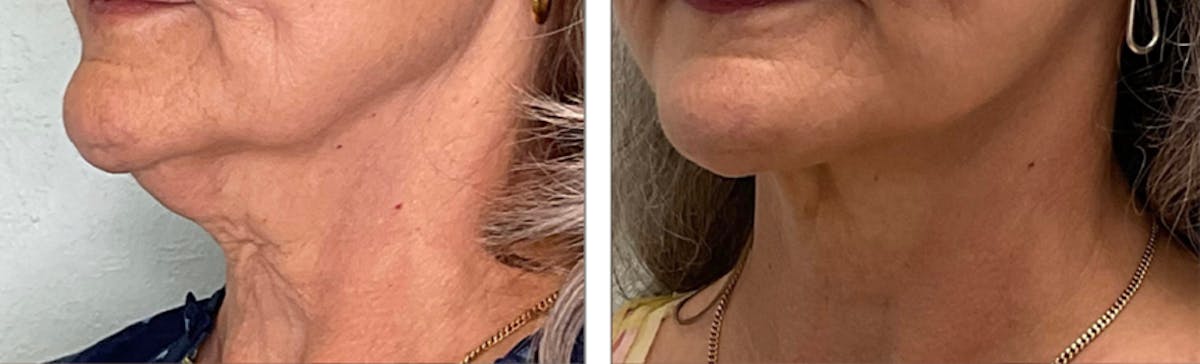 Modified Facelift Before & After Gallery - Patient 176795222 - Image 2