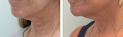 Modified Facelift Before & After Gallery - Patient 176795223 - Image 1