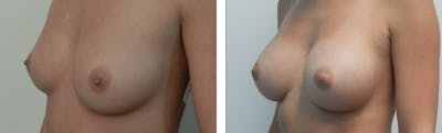 Breast Augmentation Before & After Gallery - Patient 176791820 - Image 1