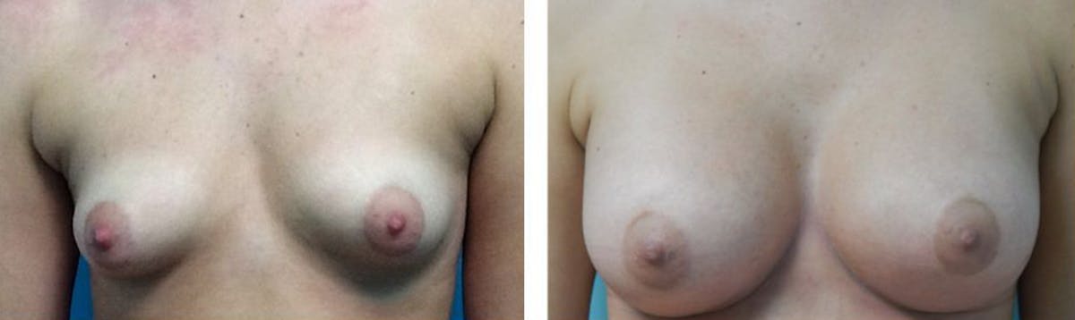 Breast Augmentation Before & After Gallery - Patient 176791823 - Image 1