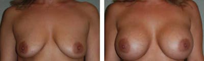Breast Augmentation Before & After Gallery - Patient 176791824 - Image 1