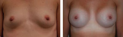 Breast Augmentation Before & After Gallery - Patient 176791826 - Image 1