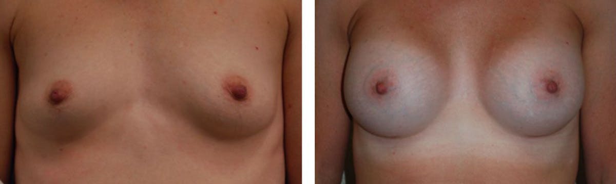 Breast Augmentation Before & After Gallery - Patient 176791826 - Image 1