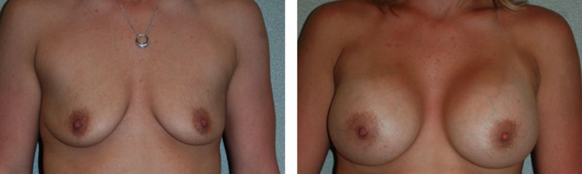 Breast Augmentation Before & After Gallery - Patient 176791870 - Image 1